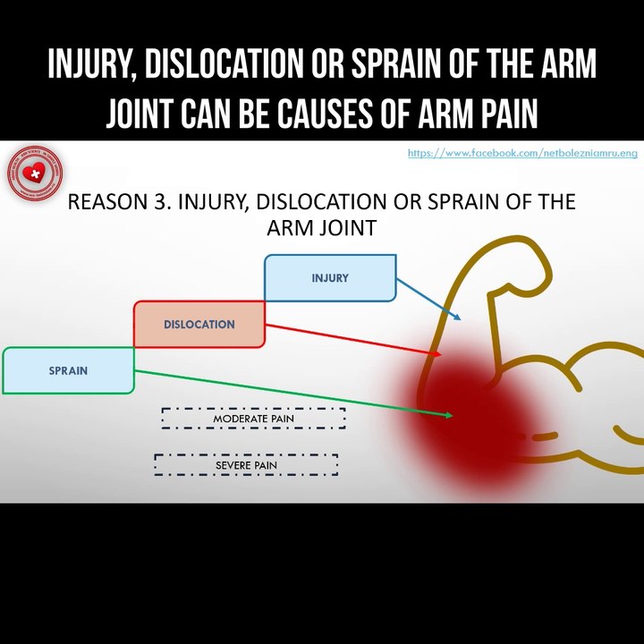 Injury, dislocation or sprain of the arm joint can be causes of arm ...