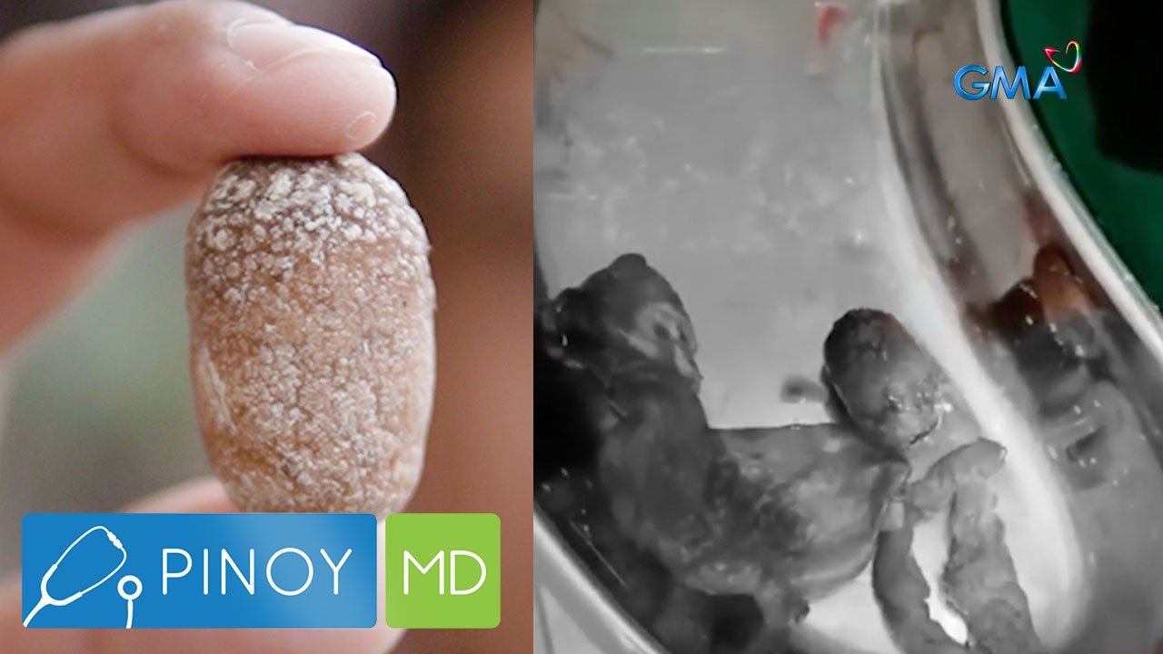 Batong kasing laki ng buto ng santol, nakuha sa katawan ng isang lalaki | Pinoy MD