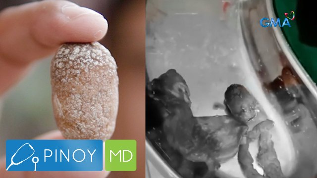 Batong kasing laki ng buto ng santol, nakuha sa katawan ng isang lalaki | Pinoy MD