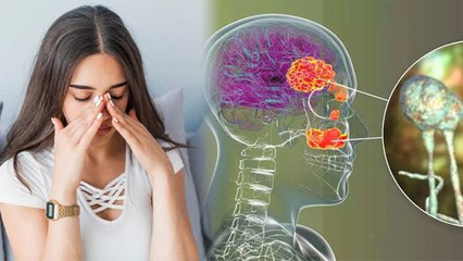 नाक का ये इन्फेक्शन दिमाग की नसों को करता है ख़राब, कारण जानकर उड़ेगे होश ।  Boldsky *Health