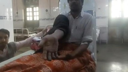 उज्जैन: डॉक्टर की गलती से युवक का हाथ हुआ खराब, अब काटी जाएगी अंगूलियां