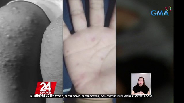 DOH: walang outbreak ng HFMD sa bansa; nasa 155 lang ang naitalang kaso mula Oktubre | 24 Oras