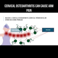 Cervical osteoarthritis can cause arm pain