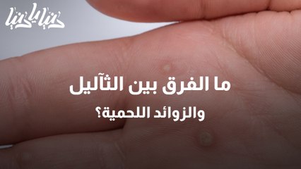 الثآليل الشائعة بين الأسباب والعلاج