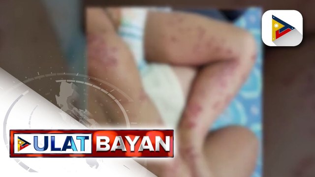 Outbreak sa hand, foot and mouth disease, posibleng ideklara kung mapupuno na ng mga kaso ang mga ospital