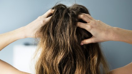 Schuppige Kopfhaut? Dann machst du vielleicht diesen Fehler