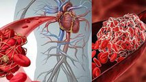 नसों में खून का थक्का जमने पर क्या होता है | Blood Clot Symptoms | Boldsky *Health