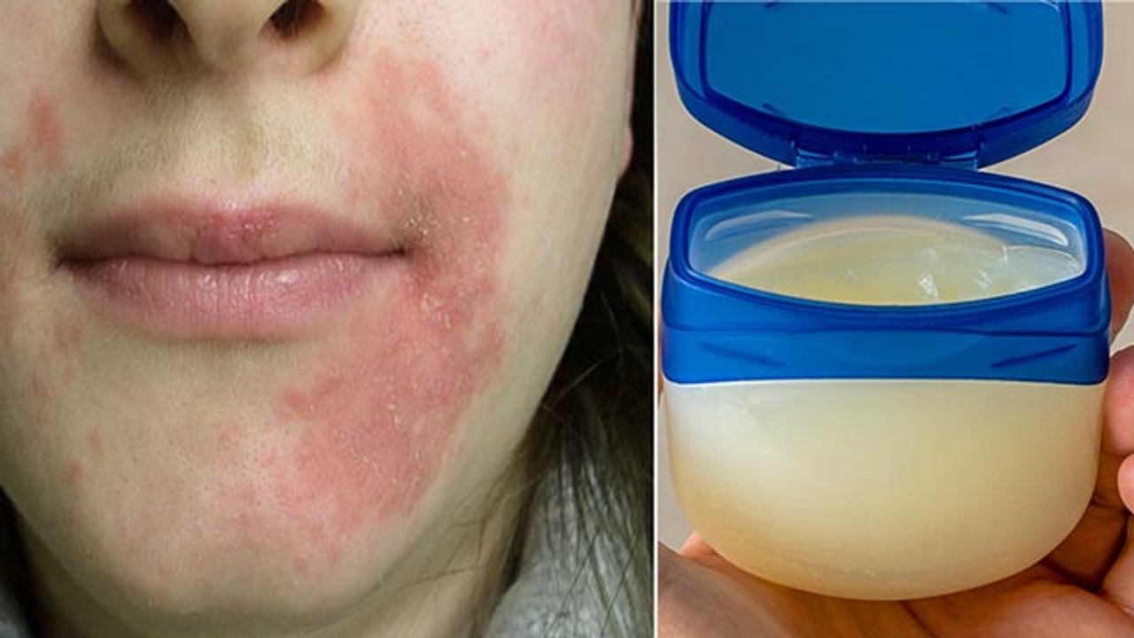 सर्दियों में पेट्रोलियम जेली लगाने से के नुकसान । Petroleum Jelly Side