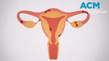 What is endometriosis?