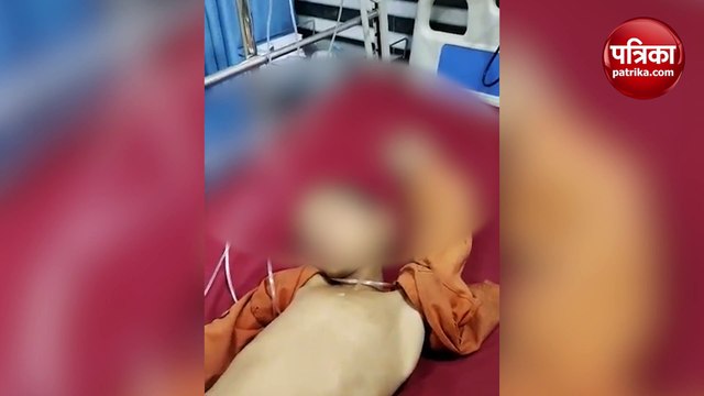 कुत्ते के काटने से बच्चे हो हुआ रेबीज, खुद भी कुत्ते की तरह भौंकने लगा