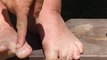 Avid hiker shares proper way to treat blisters and avoid pain & infection