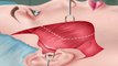 ASMR Treatment Of Cheek Lift Satisfying Surgery Animation