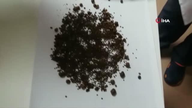 Safra kesesi değil adeta taş ocağı: 4 bin 536 taş çıktı