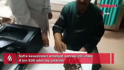 Doktor bile şoke oldu! Safra kesesinden 4 bin 536 taş çıktı