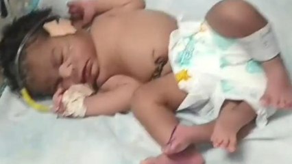 ग्वालियर के अस्पताल में मां ने चार पैर वाली बच्ची को दिया जन्म ,इसे देखने लोगों की उमड़ी भीड़