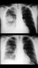SIGNO DEL TUMOR FANTASMA O TUMOR EVANESCENTE