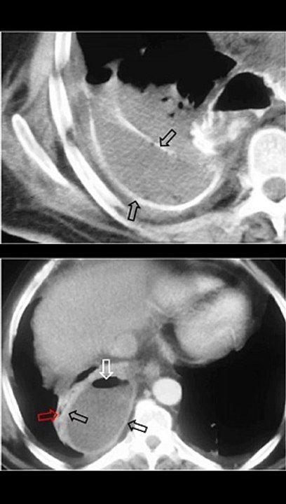 SIGNO DE LA PLEURA DESPEGADA o DIVISIÓN PLEURAL