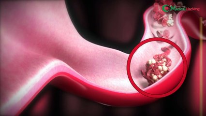 Hati hati stroke tidak pandang umur! Umur 21 tahun bisa stroke!