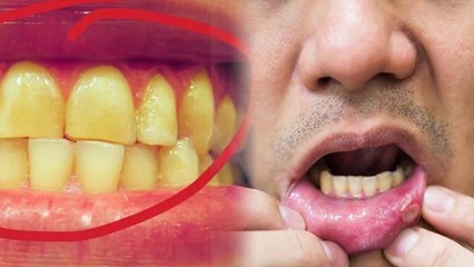 दातों का पीलापन इस खतरनाक बीमारी का लक्षण | बिल्कुल न करें नजरअंदाज | Boldsky *health