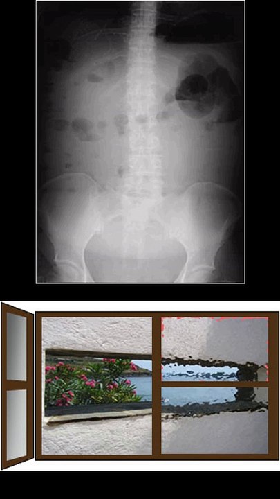 SIGNO DEL ABDOMEN EN VIDRIO DESLUSTRADO
