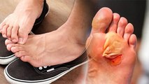 Shoes बिना Socks के पहनना खतरनाक, Fungal Infection से छाले तक का खतरा | Boldsky *Health