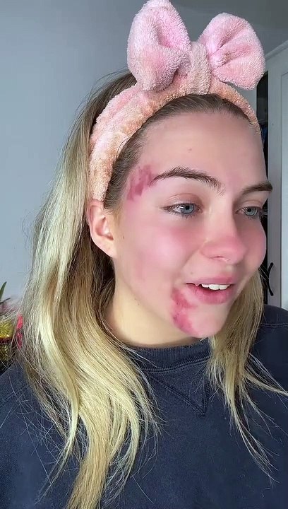 Cette fille montre sa maladie de peau rare qui lui donne d'énormes plaques rouges sur le visage