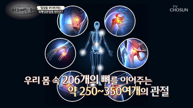 3mm의 연골이 닳아 없어지면서 고통을 동반하는 관절염☹ TV CHOSUN 20221222 방송