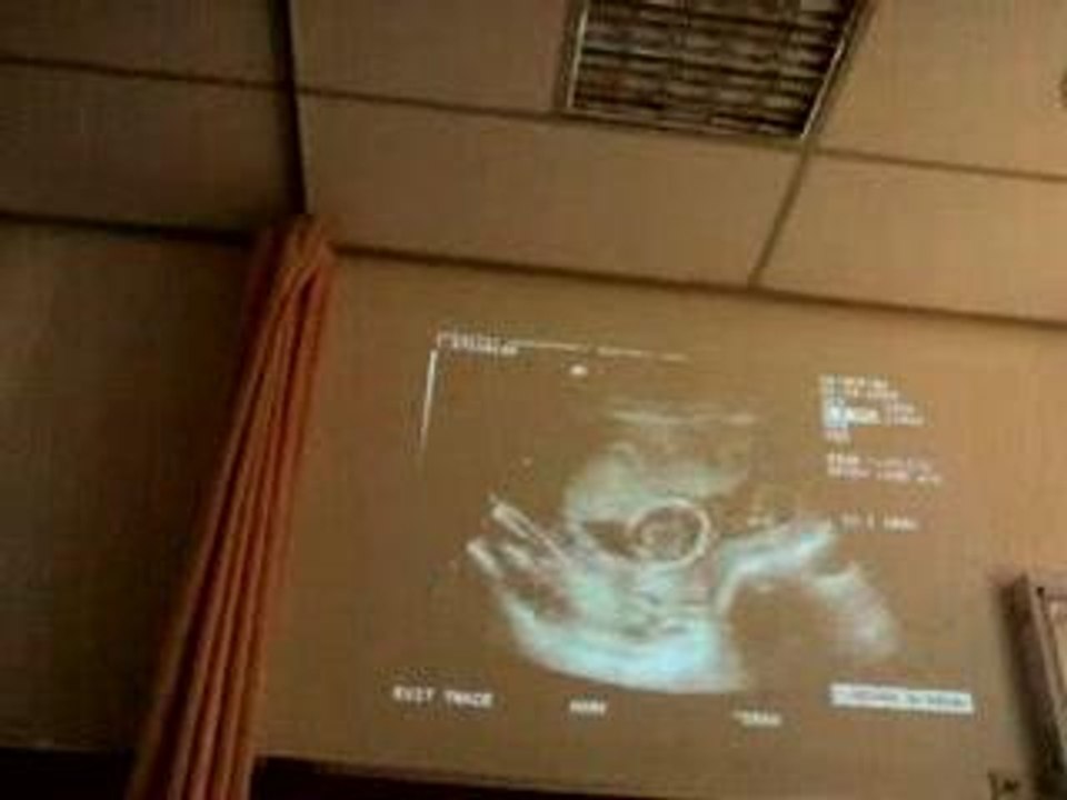 Echographie du 28 Mars 2006