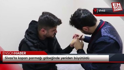 Sivas'ta kopan parmağı göbeğinde yeniden büyütüldü