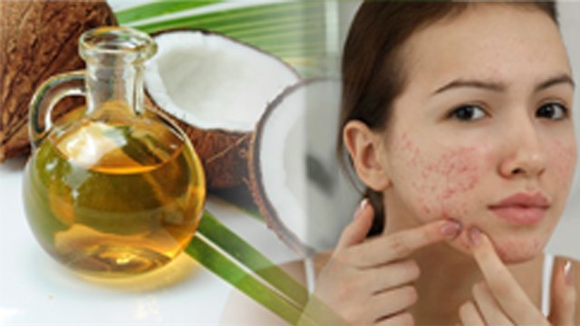 चेहरे से पिम्पल हटाने के लिए नारियल तेल कैसे लगाएं | नारियल तेल चेहरे पर लगाने से क्या होता है |