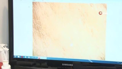 Uzmanından, kış aylarında saçta kepeklenmeye 'seboreik egzama' işareti