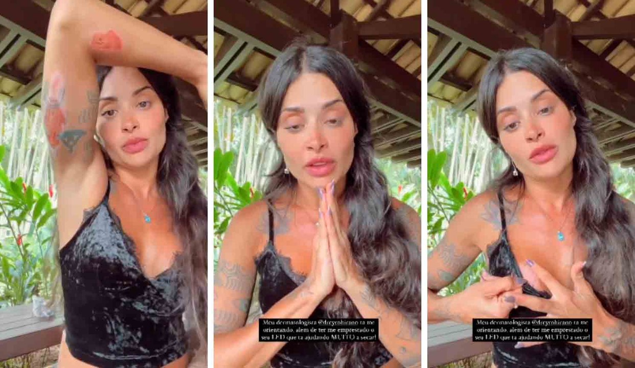 Aline Campos mostra ferimentos após acidente de moto: 'Estava carne viva'