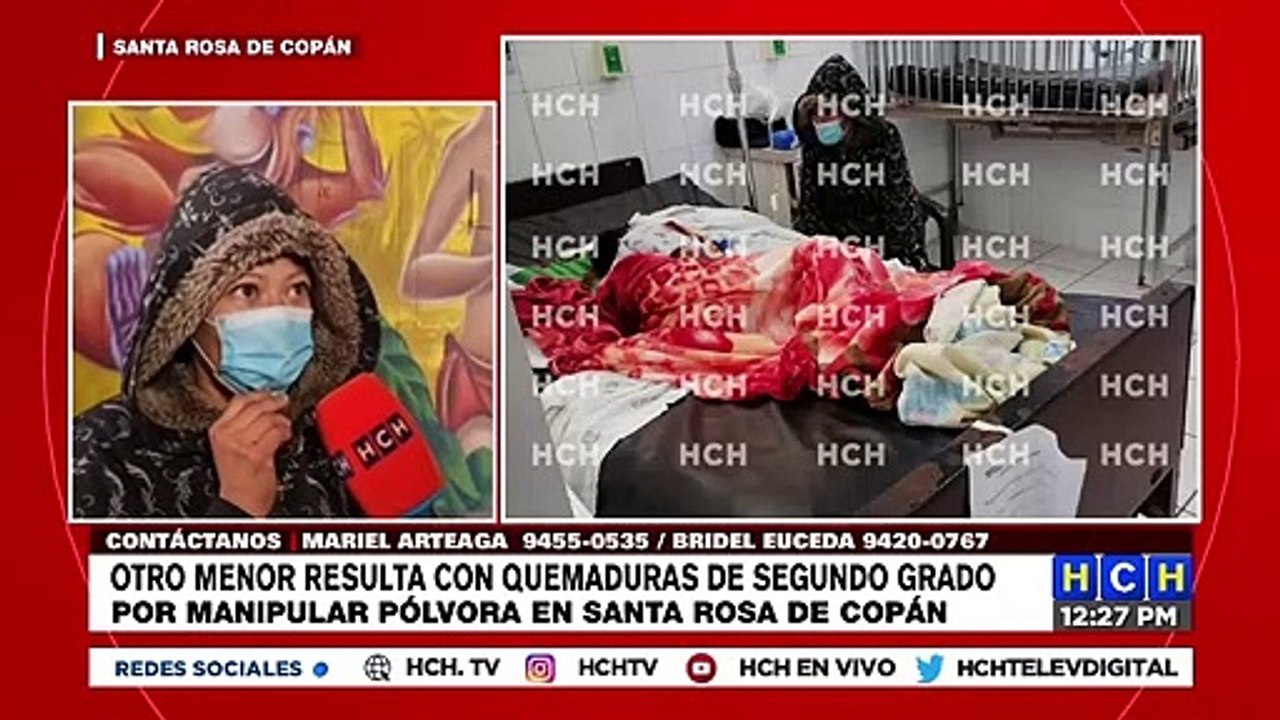 ¡La misma historia! Gravemente quemado un niño, tras "recoger cuetes" en Copán