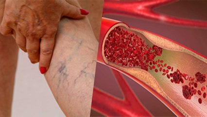 पैर की नसों में खून क्यों जमता है | पैर की नसों में खून जमने का कारण और लक्षण | Boldsky *Health
