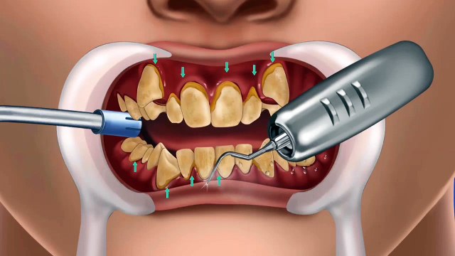 tooth decay and root canal treatment animation|| ASMR video || teeth treatment asmr #asmr