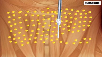Asmr Nick operation animation video