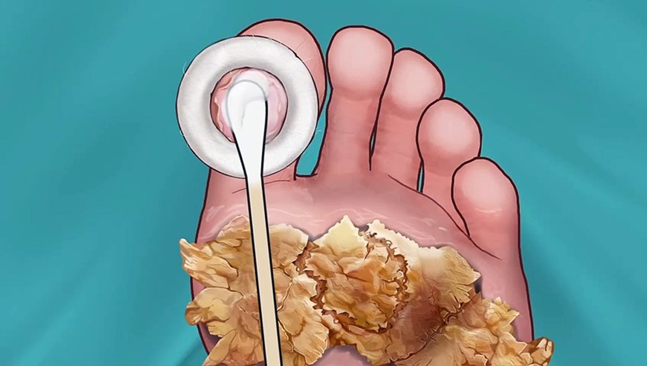 Y2Mate.is - ASMR  Surgery to Remove Large Plantar Warts Animation  Corn Foot Calluse HPV Treatment 사마귀 足底疣贅-ic2AszM9cek-1080p-1658358740497
