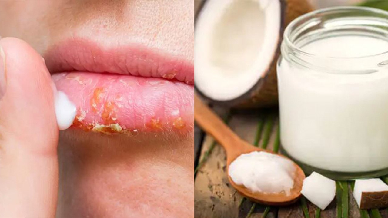 Winter में Dry Lips ठीक करने का Overnight Treatment | Dry Lips को कैसे ठीक करें | Boldsky *health