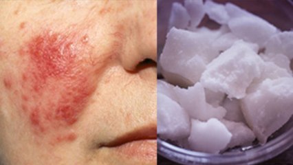 चेहरे पर लाल धब्बे क्यों होते है, चेहरे से लाल धब्बे कैसे हटाएं | Boldsky *Health