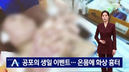 공포의 생일 이벤트…온몸에 화상 흉터