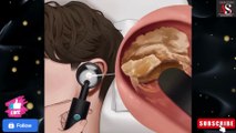 ASMR Ear wax removal|hard ear wax removal|ear wax asmr|infected ear wax removal|@asmrstudiounlimited