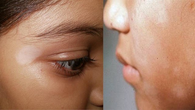 चेहरे पर सफेद दाग धब्बे होने का कारण | चेहरे पर सफेद दाग धब्बे क्यों हो जाते हैं | Boldsky *health