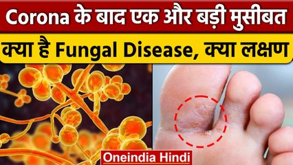 Serious Fungal Disease क्या है, Corona से भी खतरनाक कैसे, क्या हैं इसके लक्षण | वनइंडिया हिंदी *News