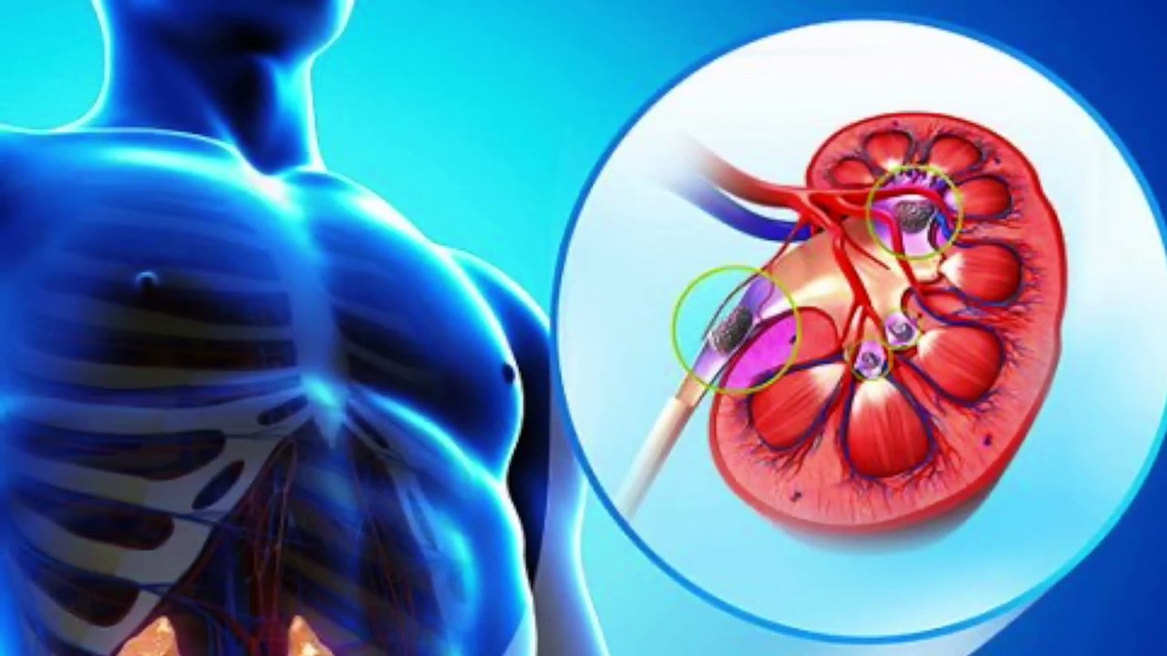 The Deeper Cause of Kidney Stones You've Never Heard About-explained by dr burg(1080p)