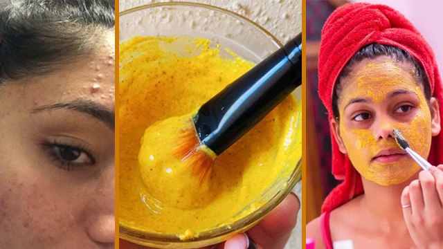 Pimples हटाने के लिए बेसन Face Pack इस तरीके से लगाएं | मुंहासों के लिए ऐसे लगाएं बेसन | Boldsky
