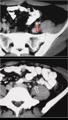 SIGNO DEL ANILLO DE TEJIDOS BLANDOS