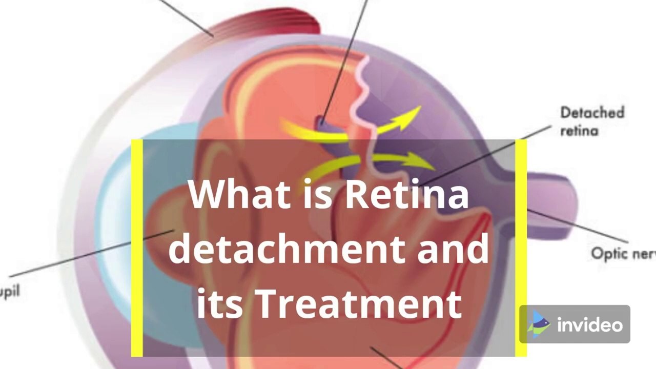 How to treat Retina Detachment, Type of Retina detachment, how diabetes escalate retina detachment.