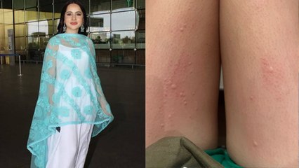 Urfi Javed Dress पहनने से हुआ बुरा हाल, Body पर हुए Red Spots Video Viral । Boldsky *Entertainment