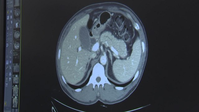 '침묵의 암' 췌장암 치료 실마리 찾았다...발병 원인 따라 6개로 분류 / YTN