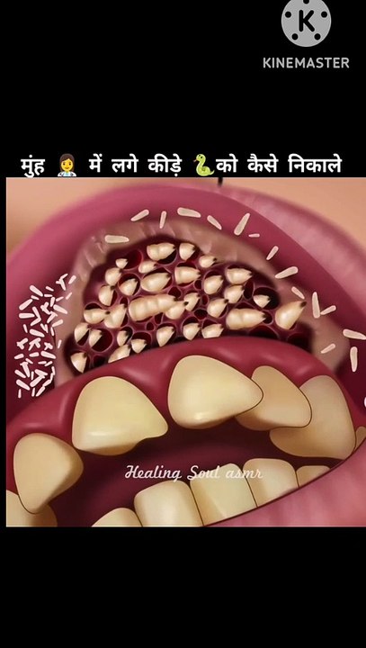 Mouth infection 